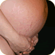 Stretch Marks